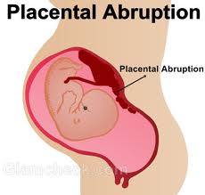 Penyebab dan Gejala Placental abruption pada Kehamilan